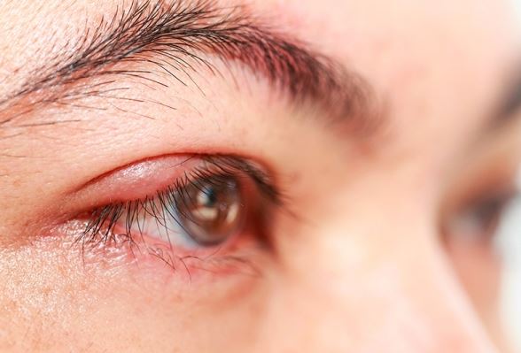 Bị lẹo mắt không nên ăn gì?