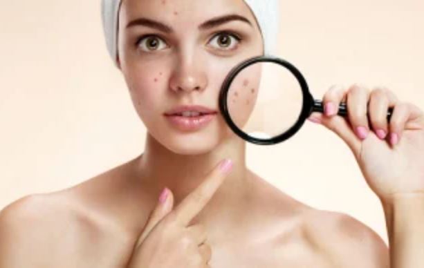 6 cách trị mụn bằng nguyên liệu tự nhiên tại nhà nhanh - hiệu quả chỉ sau 1 - 2 lần áp dụng