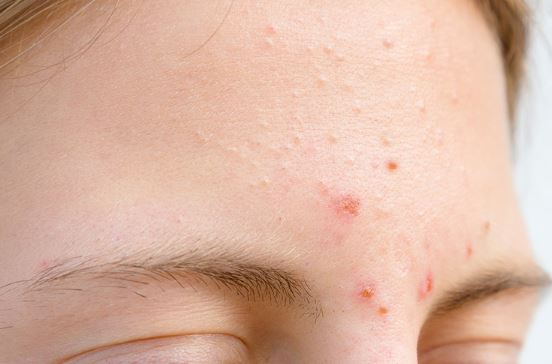 Lý do khiến bạn bị nổi mụn trên trán