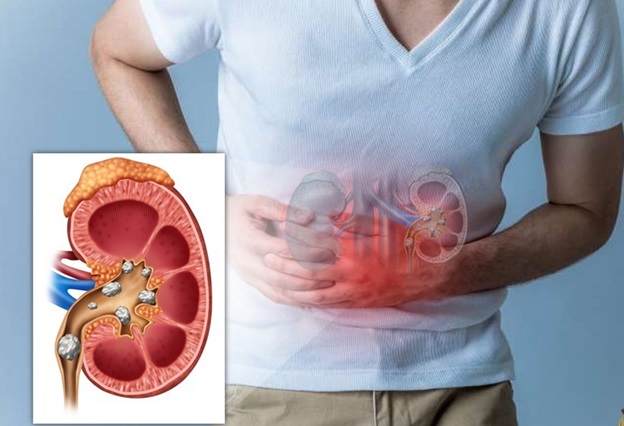 Lưu ý khi xây dựng chế độ ăn uống cho người bị sỏi thận