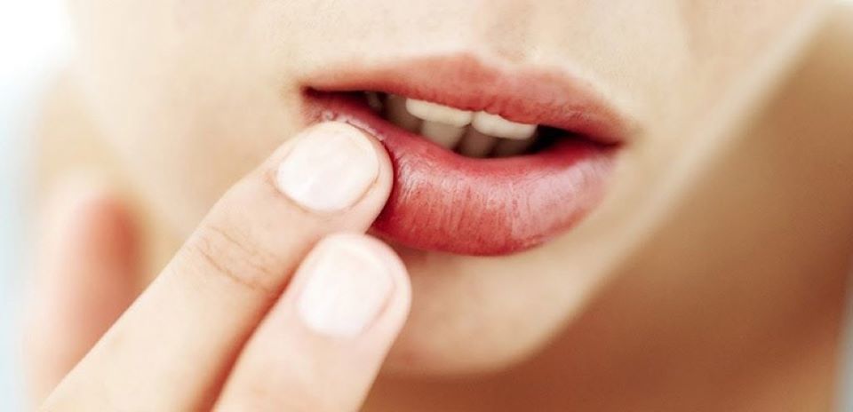 7 cách trị môi khô, nứt nẻ nhanh chóng và hiệu quả