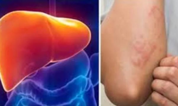 Ng&#x1EE9;a 2 v&#x1ECB; tr&#xED; n&#xE0;y b&#xE1;o hi&#x1EC7;u gan &#x111;ang k&#xEA;u c&#x1EE9;u, v&#x1ECB; tr&#xED; th&#x1EE9; nh&#x1EA5;t nhi&#x1EC1;u ng&#x1B0;&#x1EDD;i l&#xE0;m t&#x1B0;&#x1EDF;ng b&#x1EC7;nh ngo&#xE0;i da