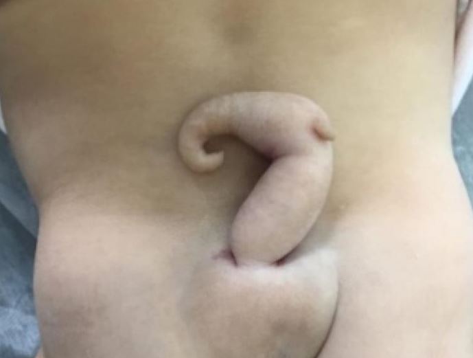 Bé gái chào đời với chiếc đuôi dài 6cm