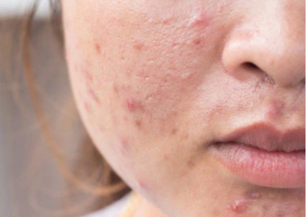 4 bệnh về da thường gặp khi thời tiết nắng nóng