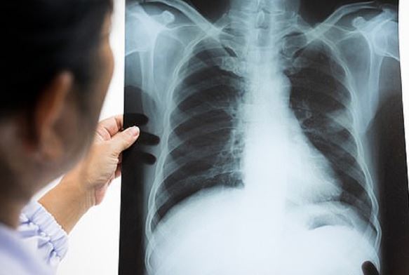 4 dấu hiệu cảnh báo ung thư phổi, có một cũng cần đi khám sớm