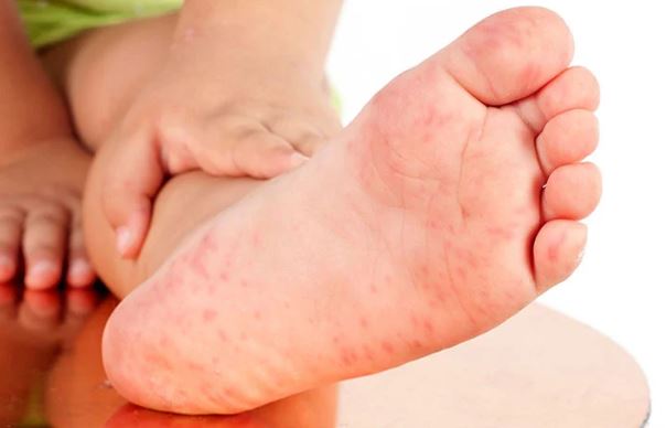 Lòng bàn chân có 4 dấu hiệu này chứng tỏ chức năng gan của bạn đang suy giảm, ai không có thật đáng mừng