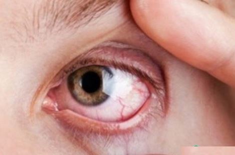 Những điều bạn cần biết về bệnh tăng nhãn áp