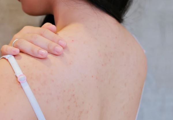 7 mẹo trị mụn lưng triệt để giúp nàng tự tin diện đồ gợi cảm ngày hè