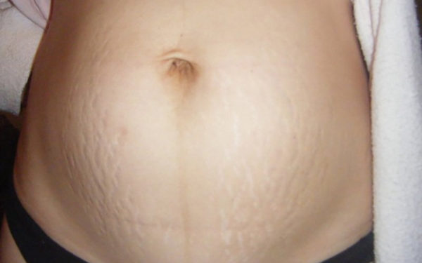 Khắc phục tình trạng rạn ra sau sinh không tốn tiền