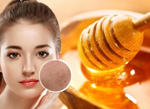 4 cách đánh bay mụn, giúp da trắng sáng mịn màng từ mật ong