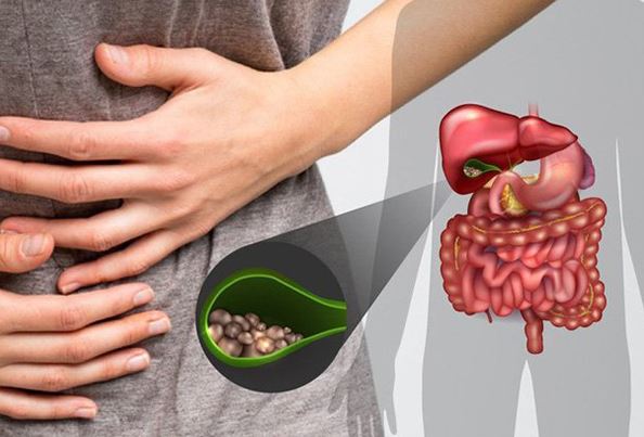 Những điều bạn cần biết về bệnh sỏi mật