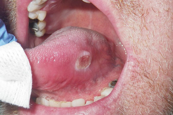 Đừng nhầm lẫn nhiệt miệng với ung thư lưỡi mà hối hận cả đời