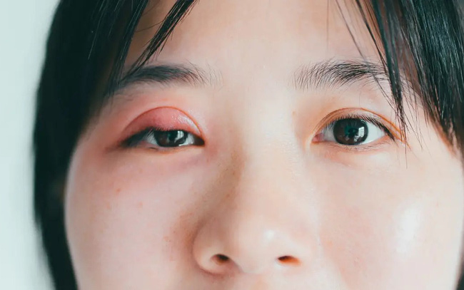 Tại sao lại xuất hiện “mụn” ở mắt?
