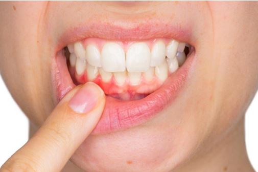 Điều bạn cần biết về bệnh viêm lợi