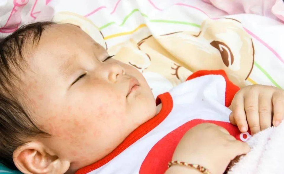 Nguyên nhân phổ biến gây sốt phát ban ở trẻ nhỏ