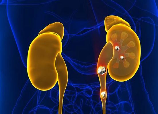 Ngày càng nhiều người mắc sỏi thận, 4 thói quen xấu ai cũng mắc phải này chính là nguyên nhân