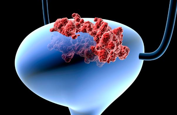 80% người bị ung thư bàng quang đều có biểu hiện sớm này