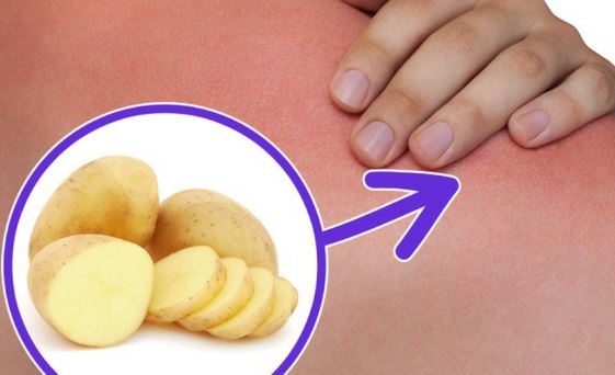 Lỡ bị bỏng, hãy cắt ngay một khoanh khoai tây đắp lên sẽ xảy ra điều kỳ diệu