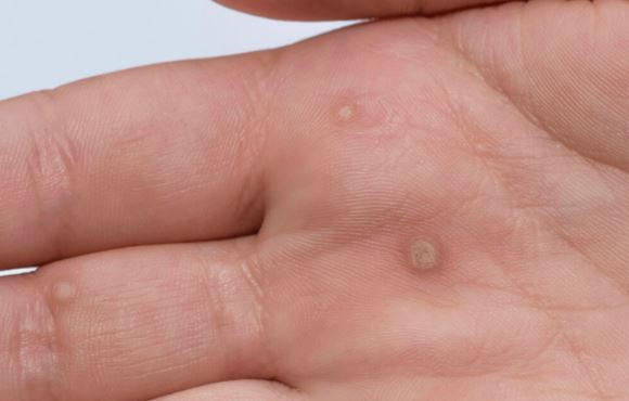 Mụn cóc và những điều bạn cần biết