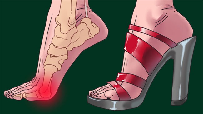 3 bộ phận cơ thể bị nguy hiểm khi bạn đi giày cao gót quá nhiều 5