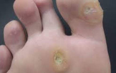 Vì sao chân bạn bị chai sần?