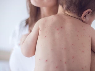 Thực phẩm không nên ăn khi bị thủy đậu