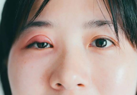 Tại sao lại xuất hiện “mụn” ở mắt?