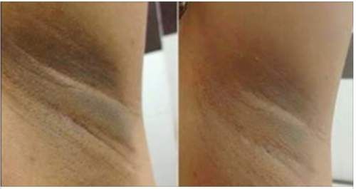 Trị thâm nách an toàn tiết kiệm bằng cách sử dụng phấn rôm