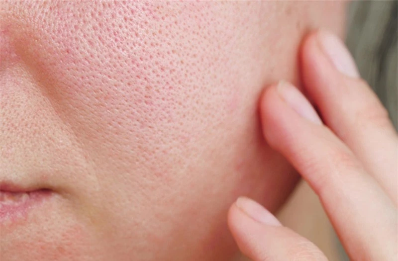 Các vấn đề thường gặp về da khi vào hè và cách khắc phục