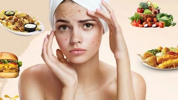 Người bị mụn không nên ăn gì?