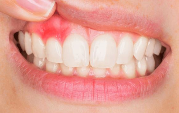 Thường xuyên chảy máu chân răng: Cảnh báo 4 căn bệnh nguy hiểm đừng chủ quan