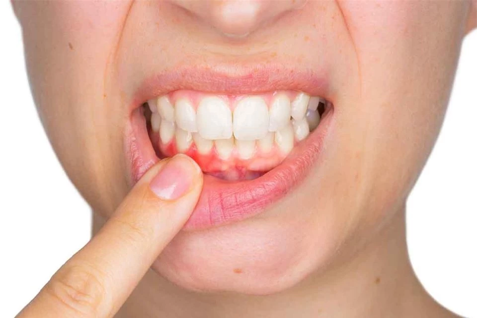 Điều gì sẽ xảy ra khi bạn đánh răng quá mạnh tay?