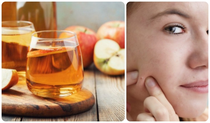 Cách trị mụn ẩn tại nhà hiệu quả sau một đêm