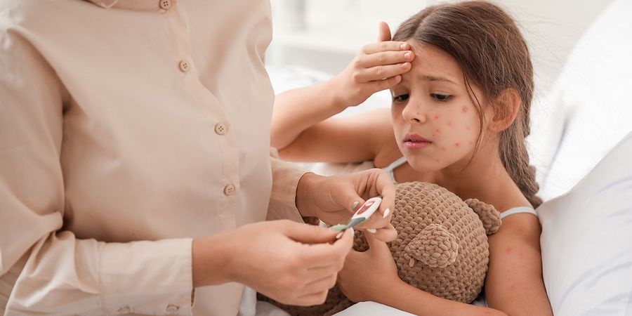 8 điều cha mẹ cần biết về bệnh thủy đậu