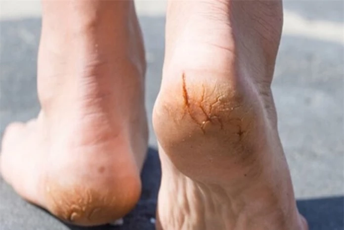 Mách bạn cách trị nứt gót chân hiệu quả bằng mỡ trăn
