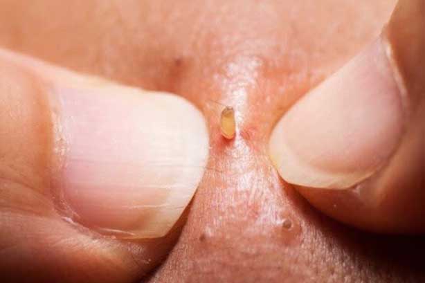 Dừng ngay việc nặn mụn ở 3 vị trí này nếu không muốn tử vong