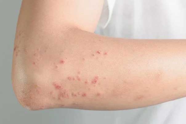 2 vị trí ngứa ngáy là dấu hiệu đường huyết tăng cao, bệnh tiểu đường đến rất gần: Đừng chủ quan