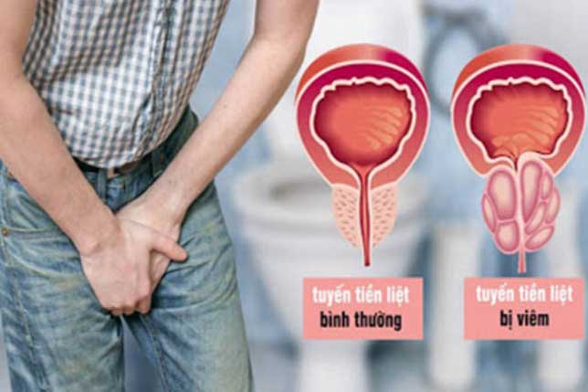 2 thói quen buổi sáng của nam giới khiến tuyến tiền liệt sinh bệnh, giữ 4 thói quen này để khỏe mạnh