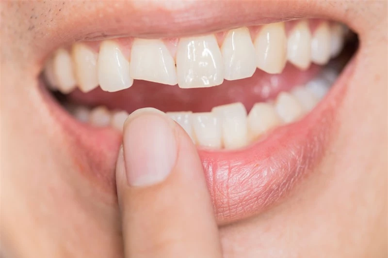 Mảng bám trên răng hình thành như thế nào?