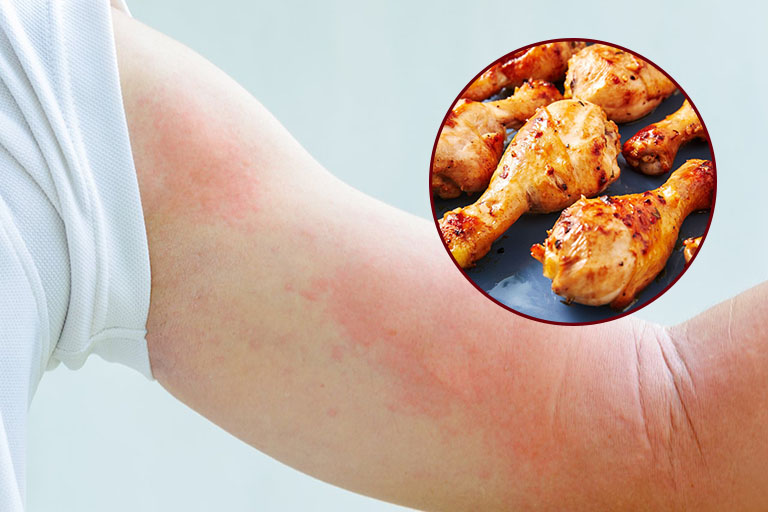 Người bị bệnh nấm da nên kiêng ăn gì?