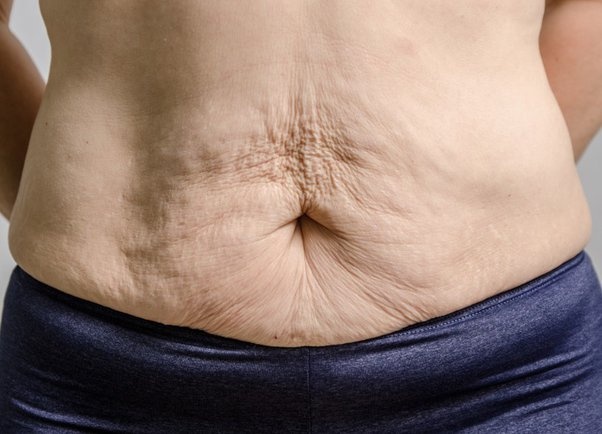 Cách làm săn chắc vùng da chảy xệ