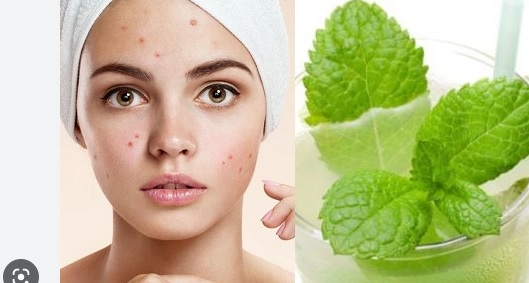 Mùa hè hãy sử dụng lá bạc hà để trị mụn