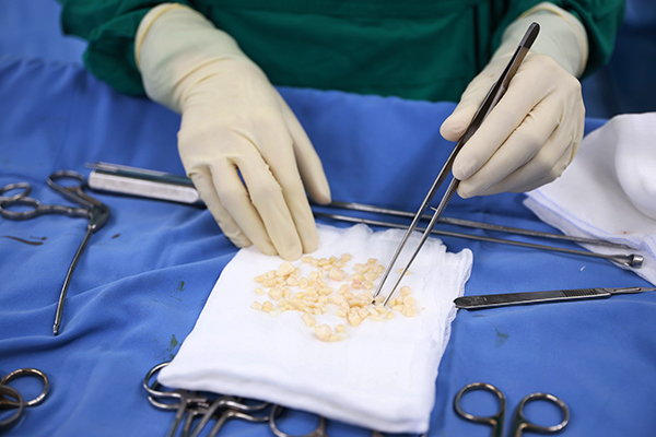 Thực hiện thành công ca mổ lấy hàng trăm viên sỏi trong khớp gối của bệnh nhân nữ