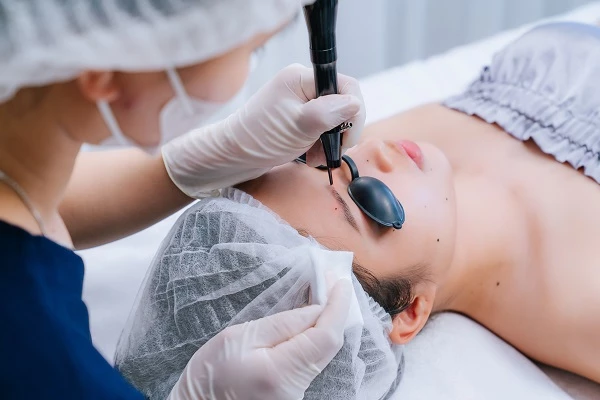 Viện thẩm mỹ DIVA tẩy nốt ruồi kém duyên bằng công nghệ Laser CO2 Fractional.