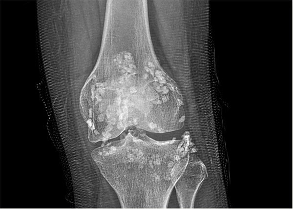 Hình ảnh X quang cho thấy khớp gối bệnh nhân chứa đầy các nốt vôi hoá