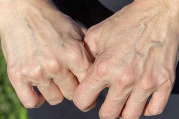 Nổi gân xanh bất thường ở 3 vùng này cảnh báo bệnh tim hoặc có khối u trong người