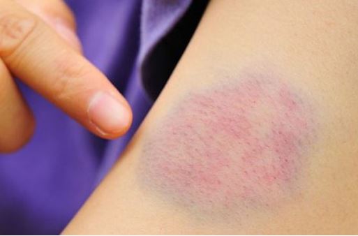 Dạ bỗng dưng có vết bầm tím không rõ nguyên nhân, cẩn trọng có thể là dấu hiệu ung thư