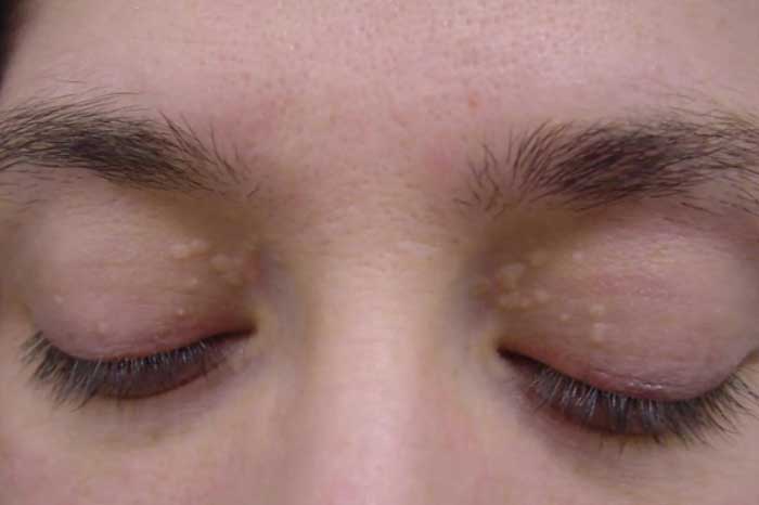 3 dấu hiệu ở mắt cảnh báo đột quỵ, ung thư 'ghé thăm'