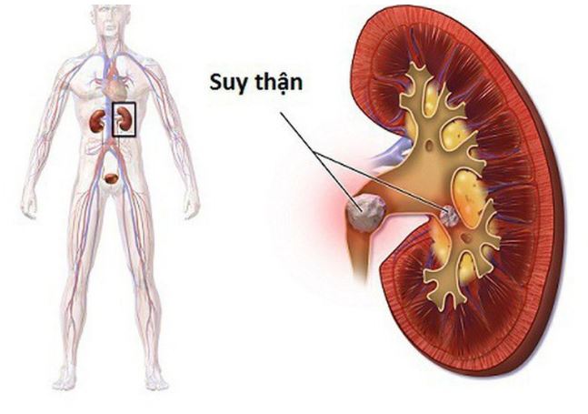 3 b&#x1EC7;nh l&#xFD; nguy hi&#x1EC3;m c&#xF3; th&#x1EC3; nh&#x1EAD;n bi&#x1EBF;t th&#xF4;ng qua 1 bi&#x1EC3;u hi&#x1EC7;n b&#x1EA5;t th&#x1B0;&#x1EDD;ng