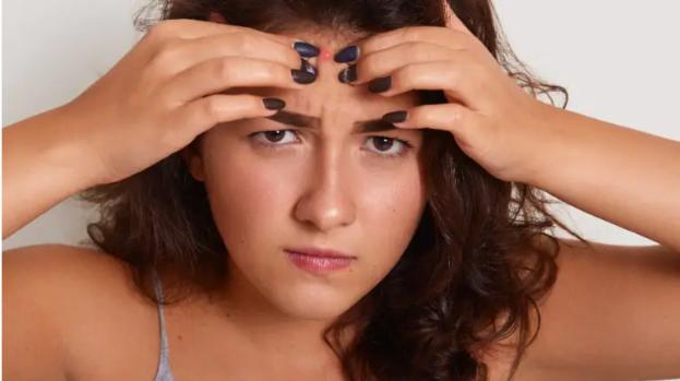 5 lý do khiến mụn trên trán nổi nhiều